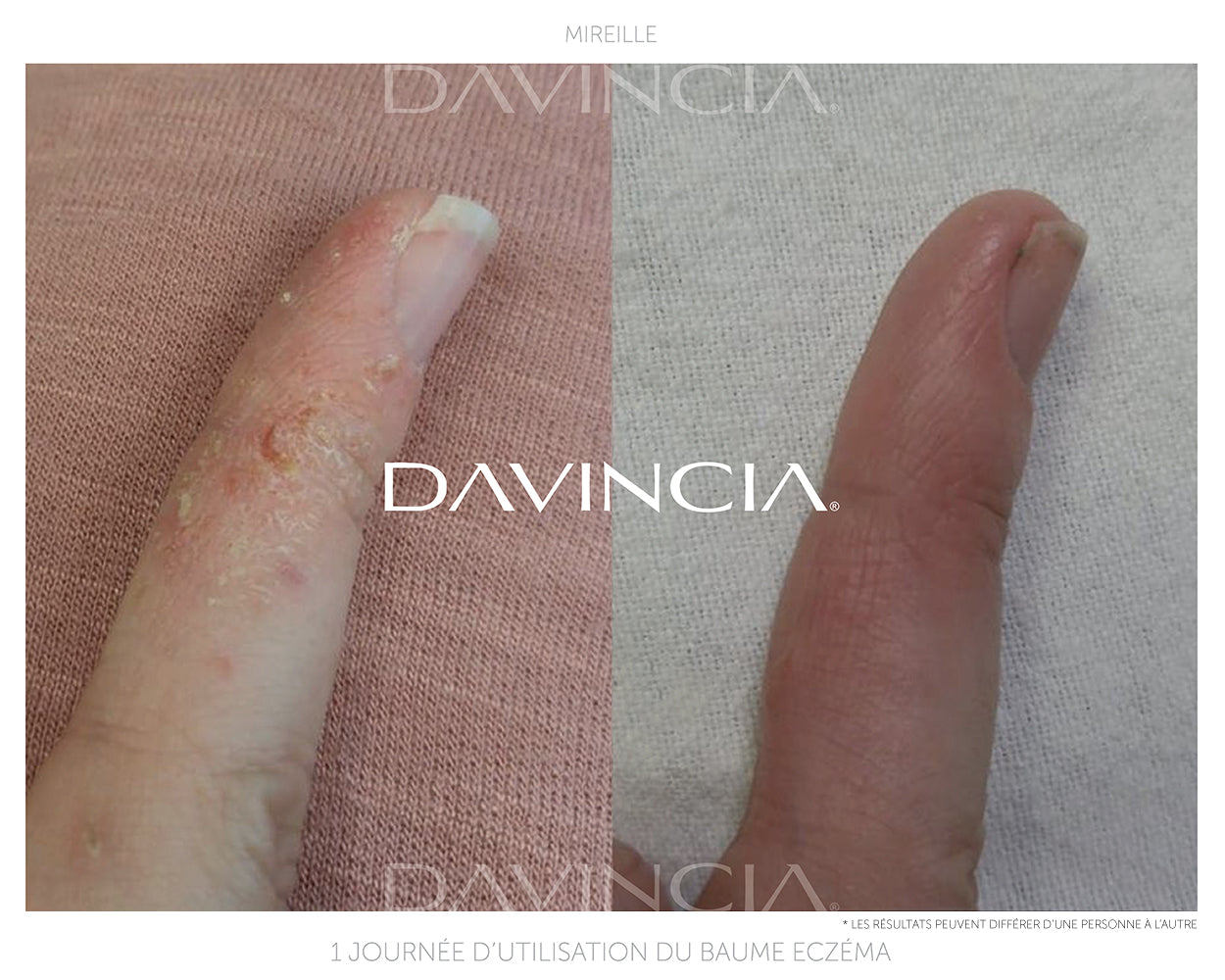 VIRTUE™ · Baume réparateur soin de l'eczéma